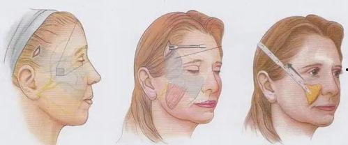 脸下垂照片,从照片看面部衰老现象